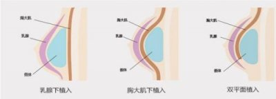 ​妙桃假体好吗(妙桃假体能用终身吗)