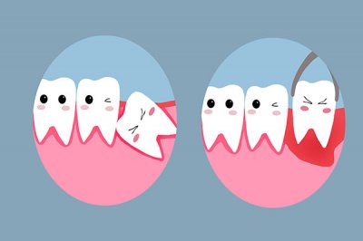 ​为什么会长智齿原因是什么（为什么会长智齿？长了就必须要拔吗？关于智齿，你
