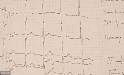 ​心律不齐 心律不齐是不是心脏病？有没有危险？医生说的明明白白