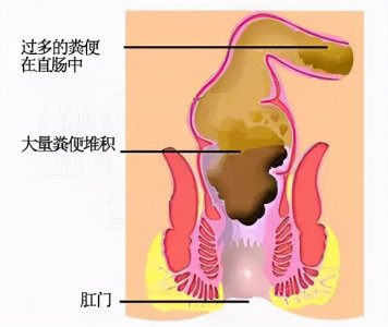 ​便秘症状 便秘的症状表现