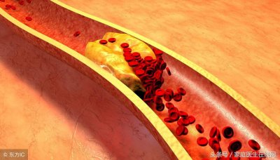​体检出血液胆固醇高？不出意外，也许是这3个原因导致
