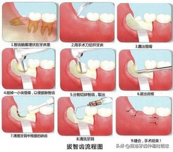 ​拔智齿后那个洞臭到恶心(拔智齿后嘴里恶臭是什么情况？)