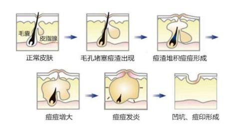 红肿痘痘怎么快速消肿 远离红肿痘痘大作战