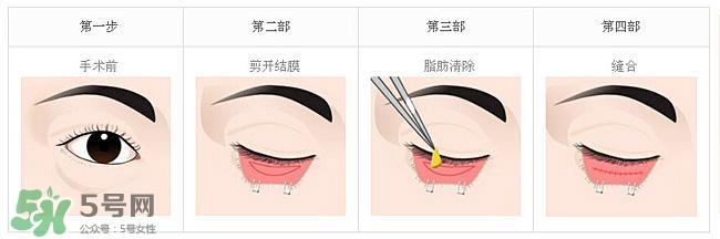 眼袋是怎么形成的？手术去眼袋安全吗